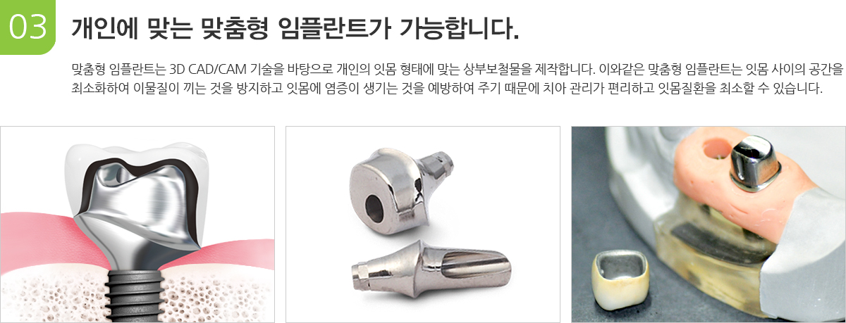 개인에 맞는 맞춤형 임플란트