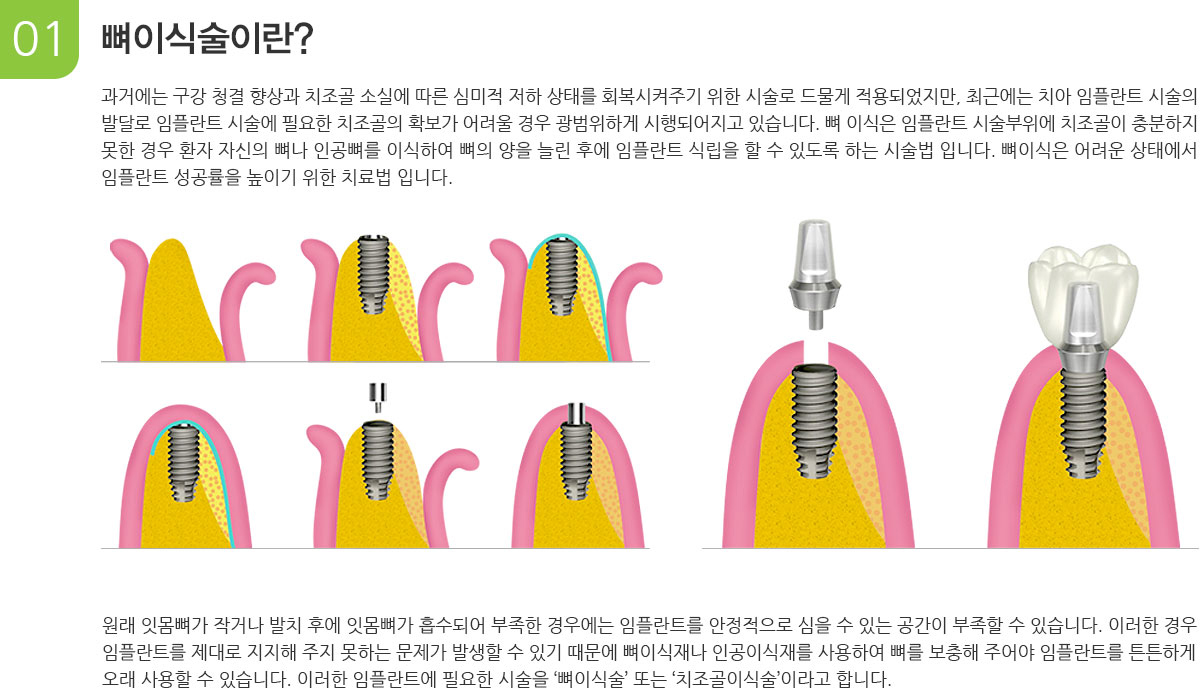 뼈이식술이란?