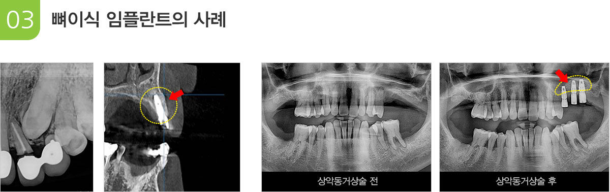 뼈이식 임플란트의 증례