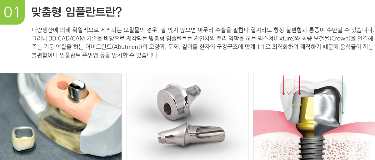 맞춤형 임플란트란?