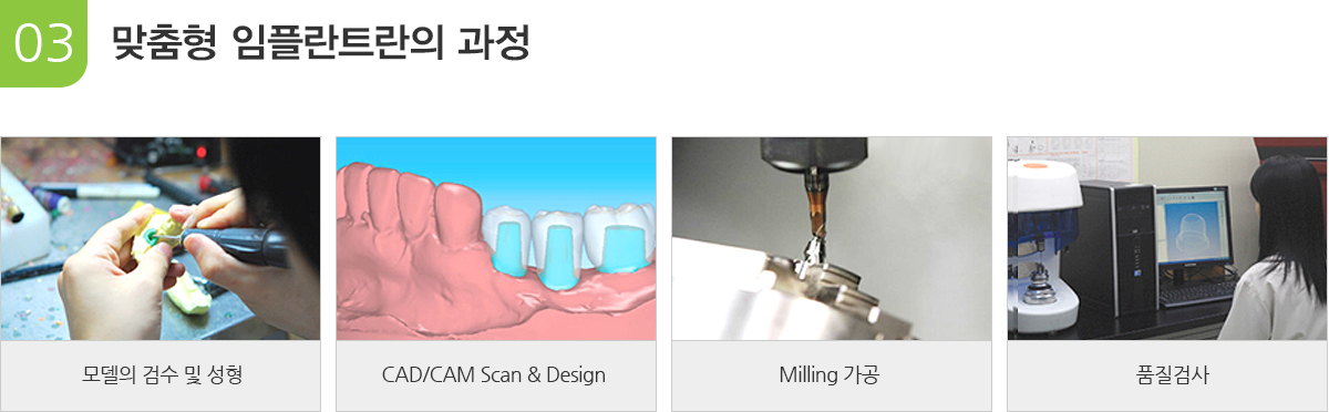 맞춤형 임플란트의 과정