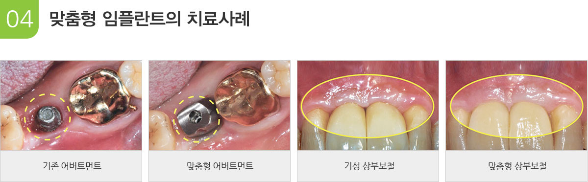 맞춤형 임플란트의 치료사례