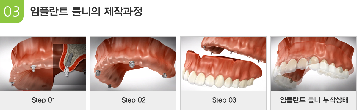 임플란트 틀니의 제작과정