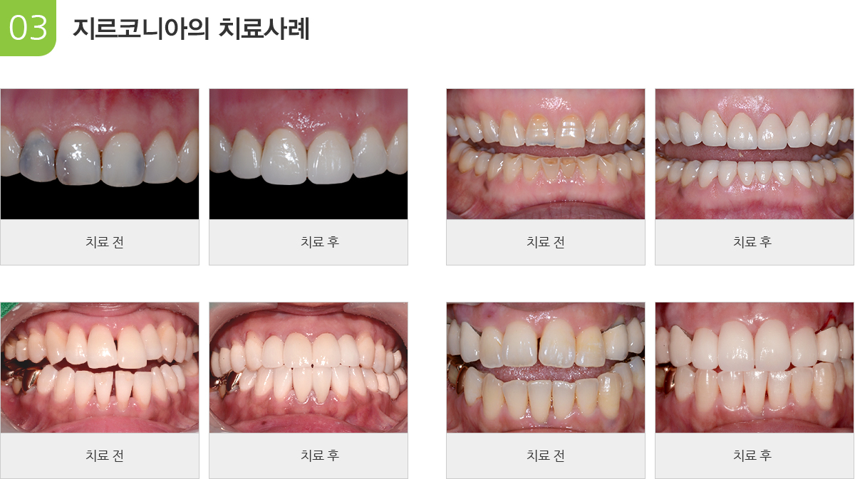 지르코니아의 치료증례