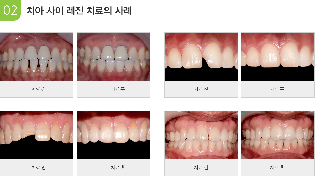 치아 사이레진 치료의 사례