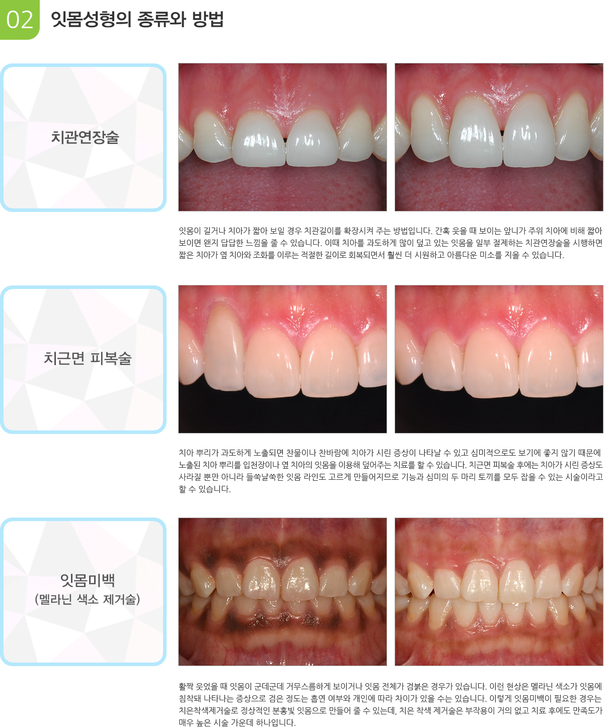 잇몸성형의 종류와 방법