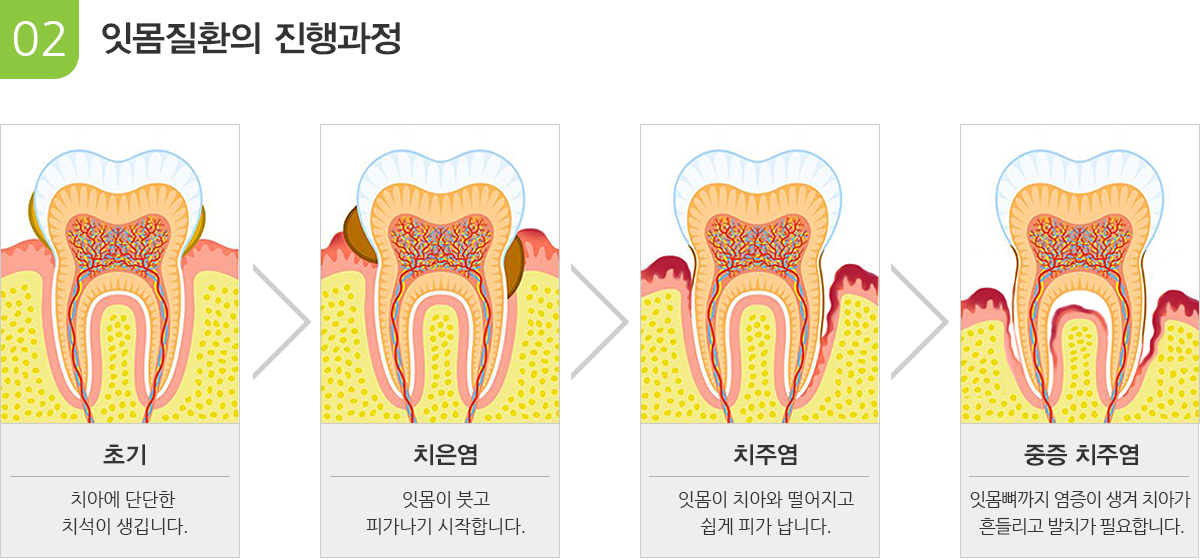 잇몸질환의 진행과정