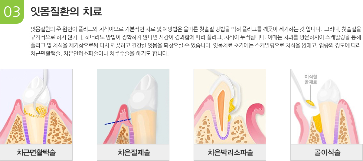 잇몸질환이 치료