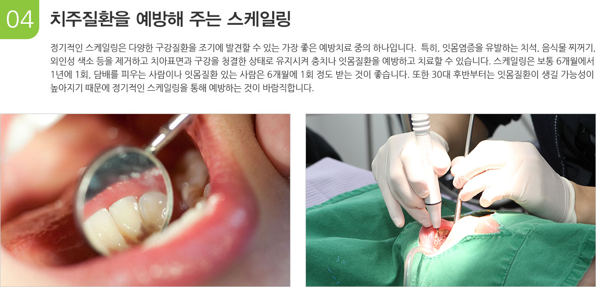 치주질환을 예방해 주는 스케일링