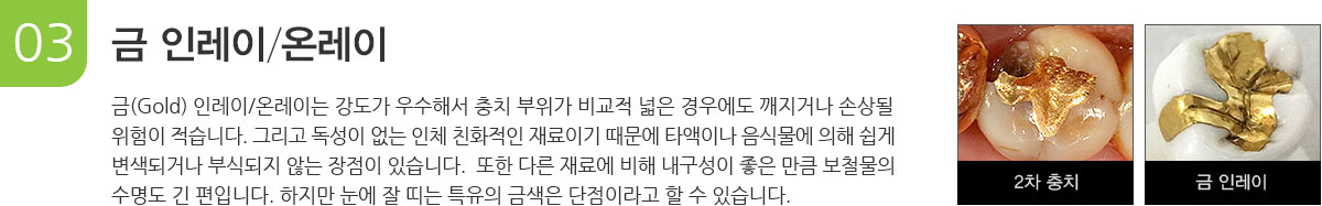 금 인레이온레이