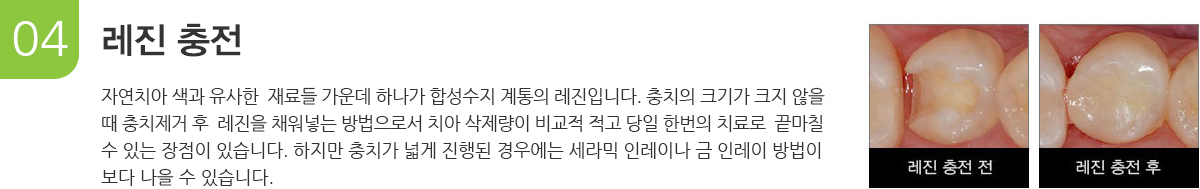 레진충전