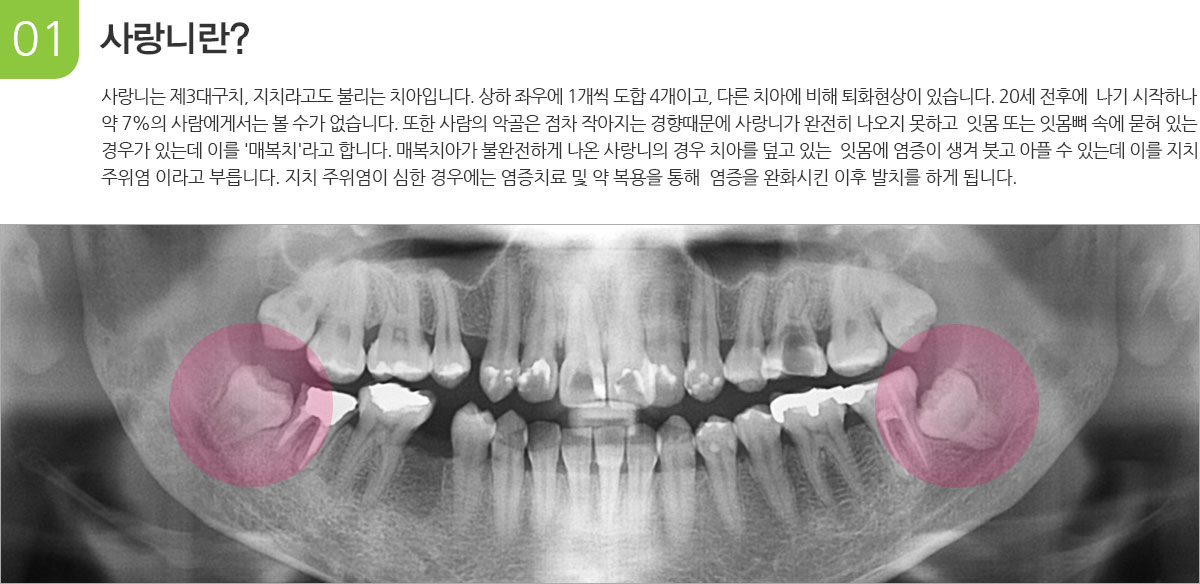 사랑니란?