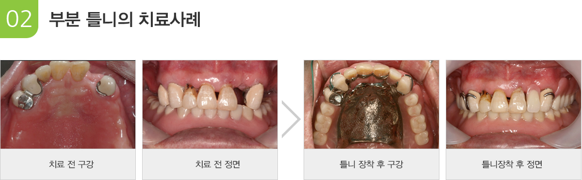 부분틀니의 사례