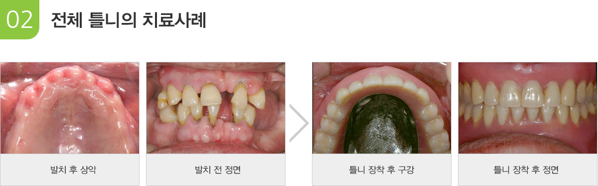 전체틀니의 사례